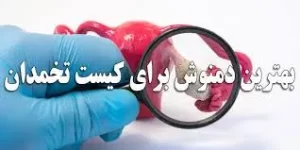 بهترین دمنوش برای کیست تخمدان